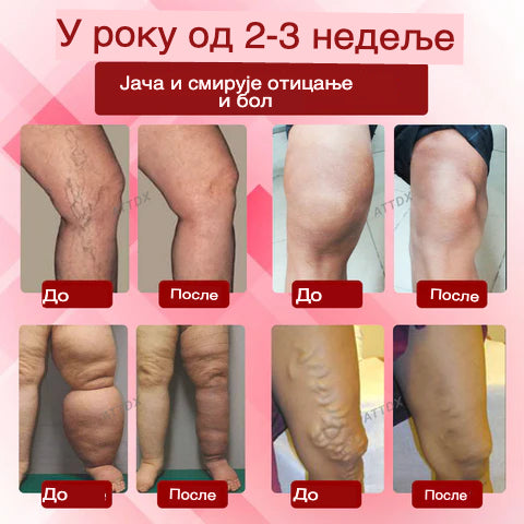 EdemaCare krema